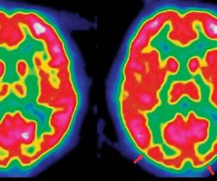 Causes of Autism Spectrum Disorder